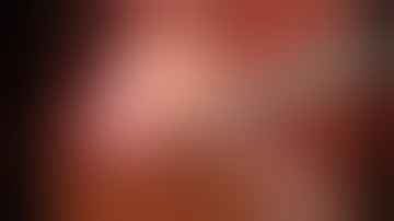 Dissection of the Calot