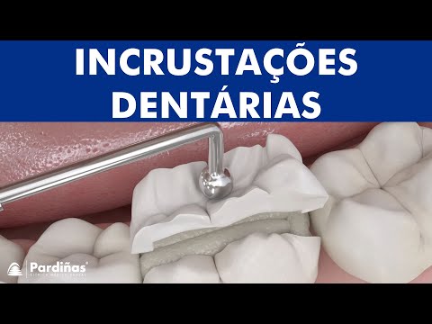 Vídeo: O que é uma incrustação dentária?