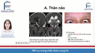 MRI OF THE CRANIAL IN THE DIAGNOSIS OF DILIPPINES