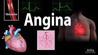 Angina: เสถียรไม่เสถียร Microvascular และ Prinzmetal ภาพเคลื่อนไหว