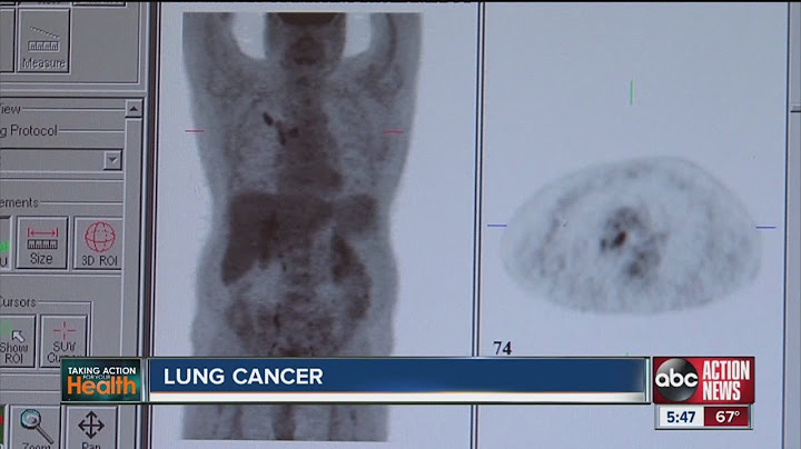 Why lung cancer is one of disease's most deadly forms