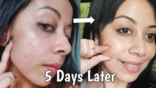 How I Repaired My Skin Barrier in 5 Days (At Home, Affordable Products) #skincare