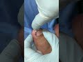 Ep_8731 Ingrown toenail removal 👣 เล็บมันฝังอยู่ในเนื้อ 😅 (clip from Thailand)