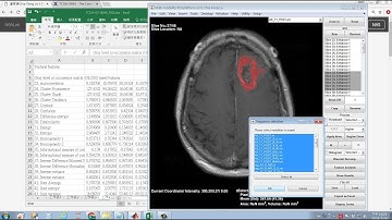 5/5 Extraction of Radiomic Features