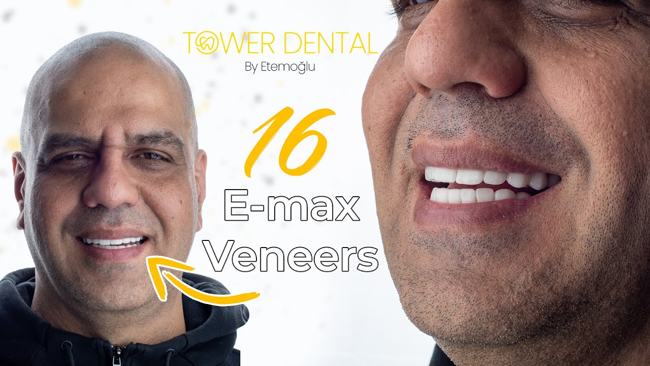 16 EMAX VENEERS Best Dental Implant Turkey Mr. Asud Iqbal from UK Tower Dental Clinic