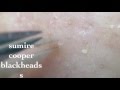 鼻角栓83.2nose blackheads（Larger version）★Tweezers only★