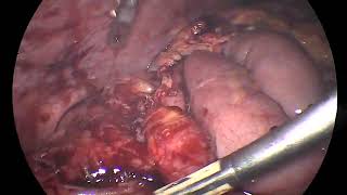 interval lap appendectomy 14-10-2025