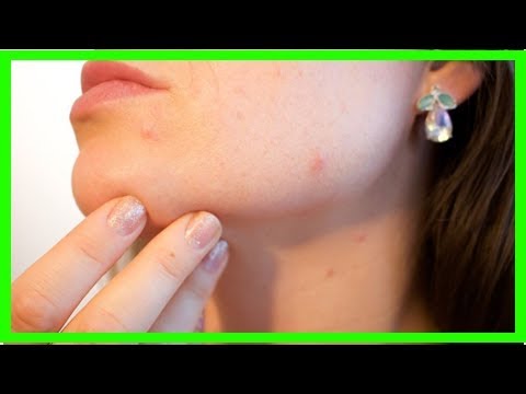 Pour réduire les cicatrices d’acné, pensez à cet ingrédient de votre cuisine !