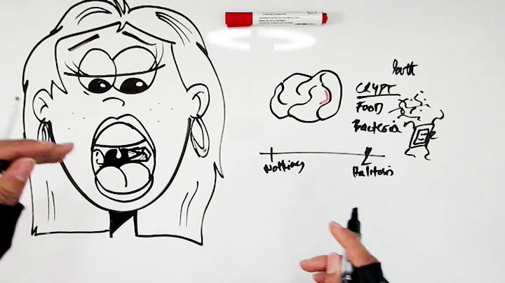 What's a Tonsil Stone and how to get rid of Tonsilloliths