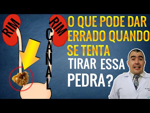 Video Complicações da cirurgia de retirada de pedras no... - youtube