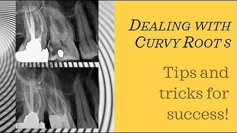 Long Curvy Root Canal with MB2