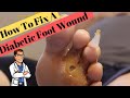 The FAST Diabetic Foot Ulcer Fix! (Type 2 Diabetes +Neuropathy)