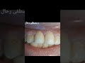 تجميل اللثة وتركيب اسنان بورسلان