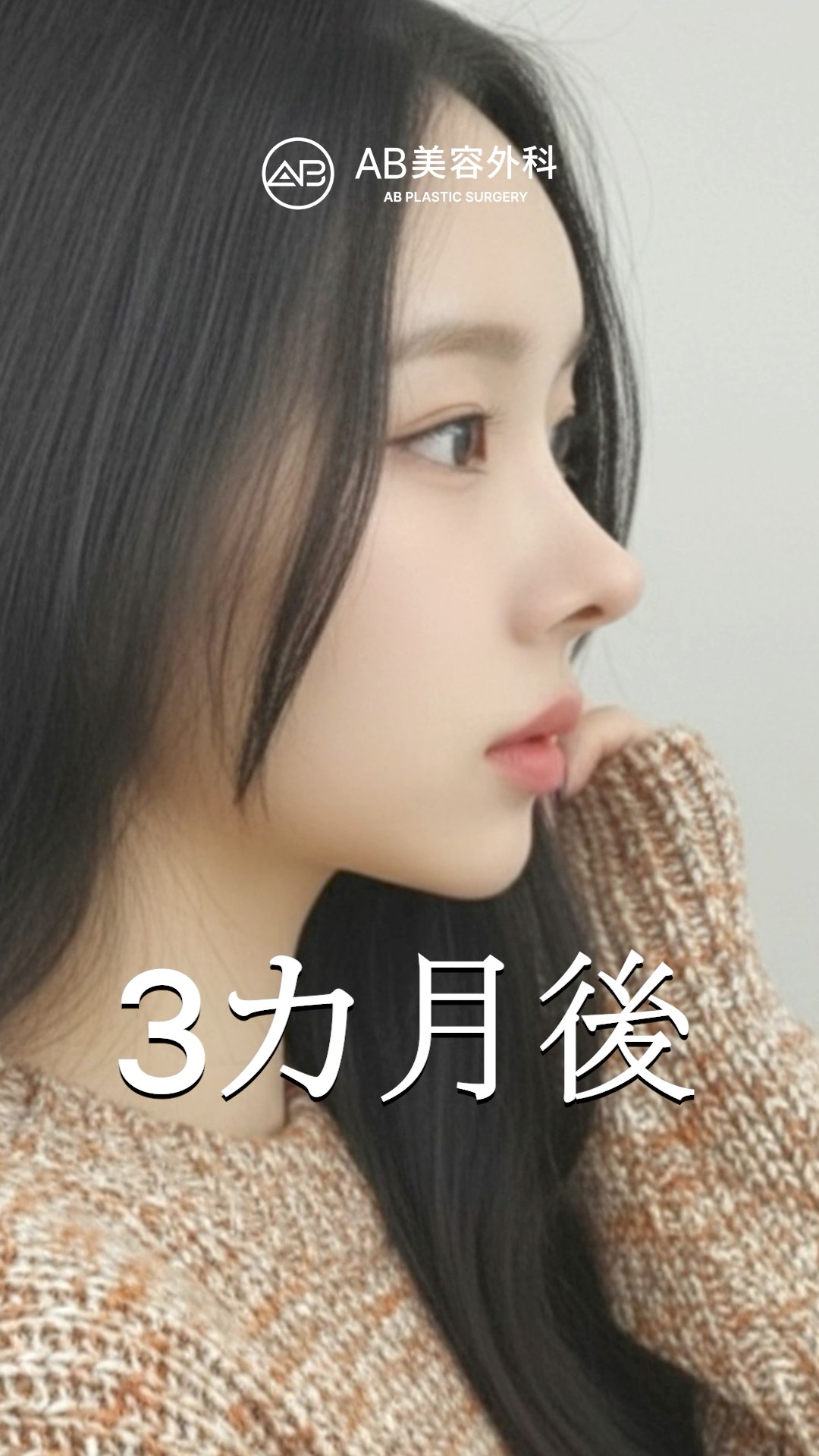 輪郭＋鼻再手術から3ヶ月、自然すぎる仕上がり！ #shorts