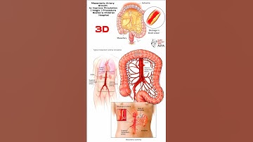 Mesenteric Artery Growth to Improve Circulation ( Magic ) Procedure  Boston’s Children Hospital #3d
