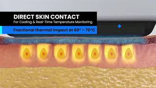 Sofwave Skin Tightening Alternative For Thermage & Ultherapy Now Available In Los Angeles & Pasadena