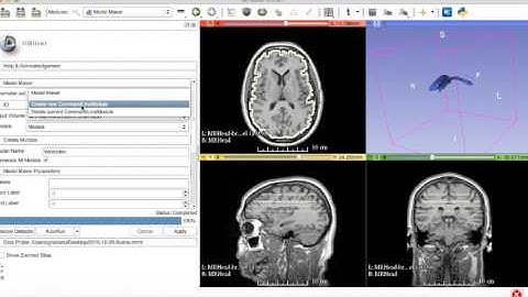 3D Slicer: Threshold Effect and Robust Statistics Segmenter