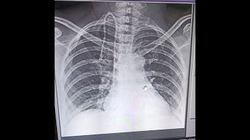 Totally Implantable Venous Access Device - Chemo Port