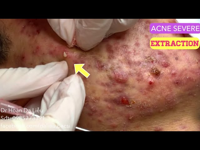 Mụn trứng cá mạch lươn cực nặng|Dermatologist, pimples, blackhead, acne conglobata extraction full