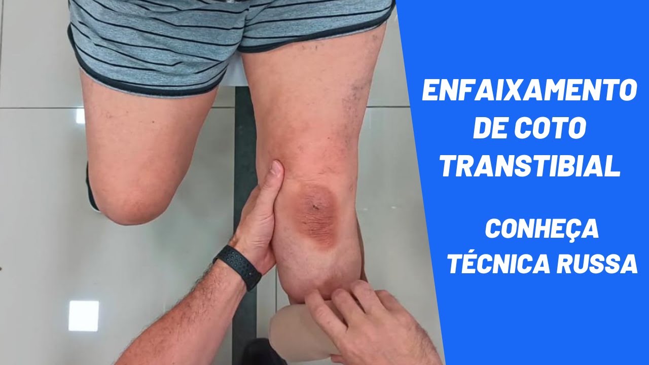 Enfaixamento do Coto Transtibial - Conheça Técnica Russa