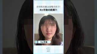 非対称改善は両顎手術で #両顎手術 #輪郭手術