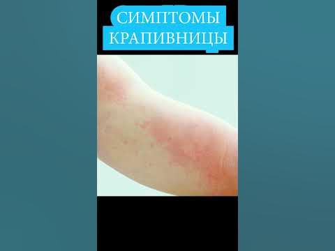 Крапивница - симптомы, фото 📌 Как выглядит крапивница у детей и ...