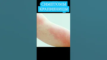Крапивница - симптомы, фото 📌 Как выглядит крапивница у детей и взрослых