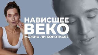 Коррекция нависшего века | Когда возможен естественный лифтинг век? | Упражнения для верхнего века