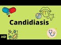 Candidiasis causes signs and symptoms diagnosis and treatment