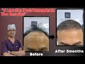 "TRANSFORMED IN 5 MONTHS! Hair Transplant Before &amp; After Results"