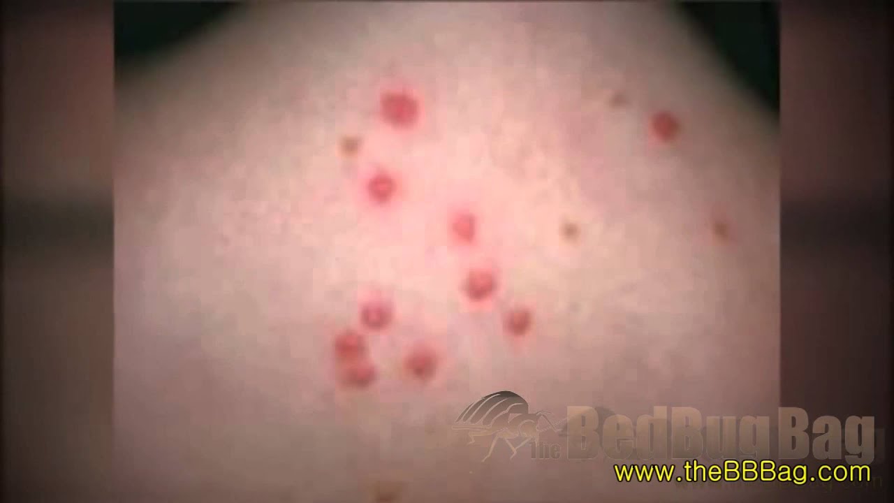 Bed Bug Rash Youtube