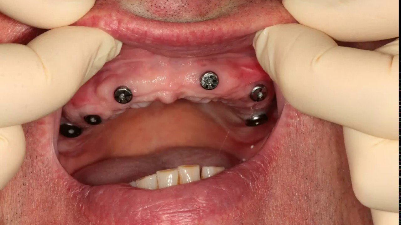 Имплантация при полном отсутствии зубов. Имплантация. Протезирование.
