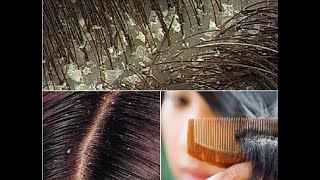 قشرة الشعر اسبابها و طرق اقتصادية لعلاجها