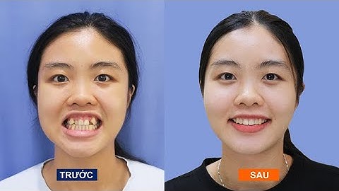 RĂNG KHẤP KHỂNH NÊN NIỀNG RĂNG HAY KHÔNG ?