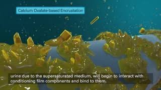 Tria Ureteral Stents Calcium Oxalate