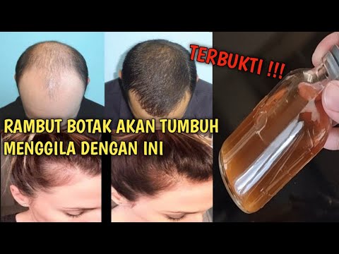 2 CARA MENGATASI KEBOTAKAN RAMBUT DAN MEMBUAT RAMBUT TUMBUH MENGGILA DLM SEMINGGU CUMA DGN BAHAN INI