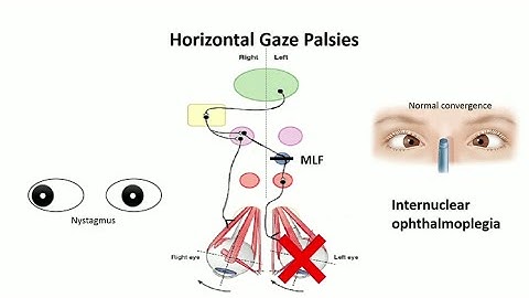 horizontal gaze palsy; conjugate horizontal gaze | pathway
