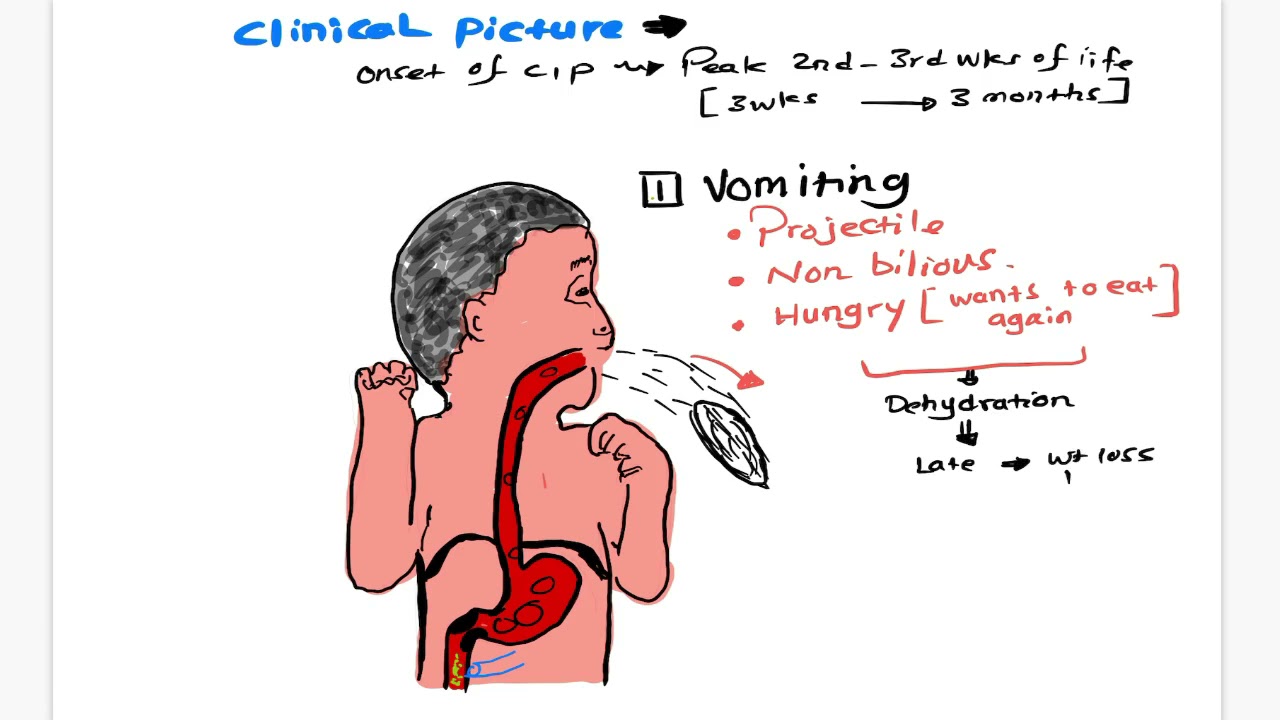 Infantile pyloric stenosis