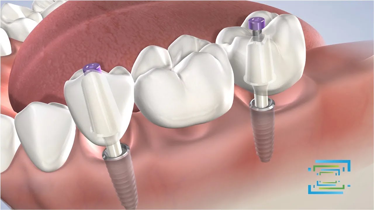 Dental Implant Benefits at Fresno Oral Maxillofacial Surgery & Dental Implant Center YouTube