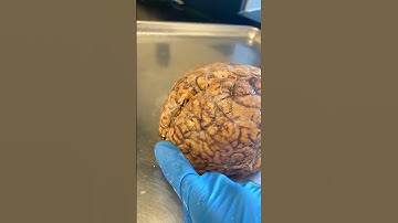 Seizures and the Brain