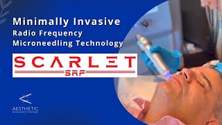 Short-Pulse Radiofrequency with microneedling | Why Should you Choose Scarlet SRF?