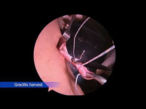 Arthroscopic ACL Reconstruction with Hamstring tendon ผ่าตัดส่องกล้องข้อเข่าเพื่อซ่อมเอ็นไขว้หน้า