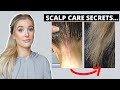 How an Unhealthy Scalp Causes Hair Damage & How to Fix An Itchy, Flaky Scalp