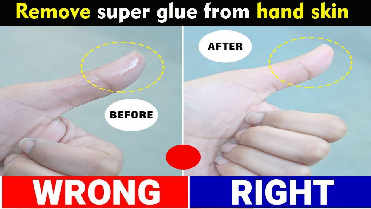 How to Get Super Glue off Your Skin