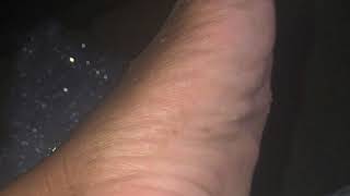 Got Callus?