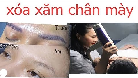 Hình ảnh xóa xăm lông mày | xóa xăm bằng laser giá | ngoc trinh spa