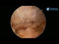 Arthroscopic Resection AC Acromioclavicular Frisella Shoulder Surgery