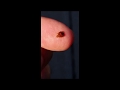 Pictures of Bed Bug Infestations