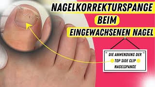 NAGELSPANGE Top Side Clip für EINGEWACHSENE NÄGEL und ROLLNÄGEL! | Podologie | Nagelkorrekturspange