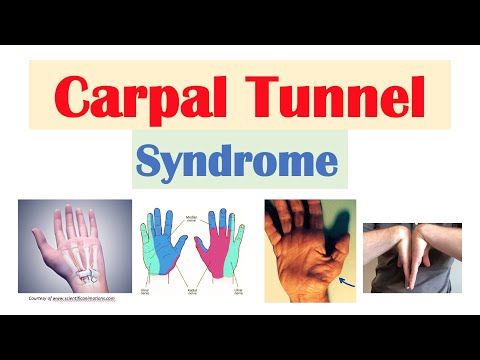 Carpal Tunnel Syndrome | Risk Factors, Pathogenesis, Signs & Symptoms, Diagnosis, Treatment